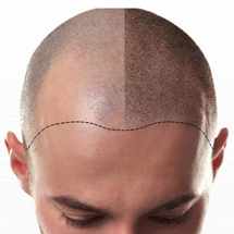 Hair Transplant for Men & Women