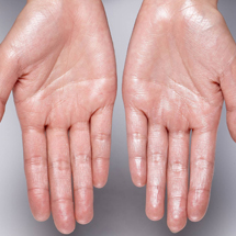 Hyperhidrosis Treatments