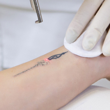 Laser Tattoo & Scar removal